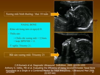 20/10/2006 67
C.M.Rumack et al. Diagnostic Ultrasound. 3rdEdition. 2005. p1039-1055
Anthony O. Odibo, MD et al. Evaluating the Efficiency of Using Second-Trimester Nasal Bone
Hypoplasia as a Single or a Combined Marker for Fetal Aneuploidy. J Ultrasound Med 2006
25:437-441
NASAL BONE
- Khảo sát trong tam cá nguyệt II.
- Thiểu sản:
+ Chiều dài xƣơng mũi < 2,5mm.
+ hoặc BPD/NB > 11.
- Ý nghĩa: Trisomy 21.
Xƣơng mũi bình thƣờng / thai 18 tuần
Bất sản xƣơng mũi: Trisomy 21
 