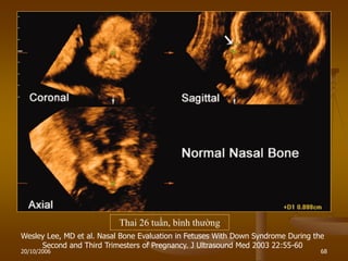 20/10/2006 68
Thai 26 tuần, bình thƣờng
Wesley Lee, MD et al. Nasal Bone Evaluation in Fetuses With Down Syndrome During the
Second and Third Trimesters of Pregnancy. J Ultrasound Med 2003 22:55-60
 