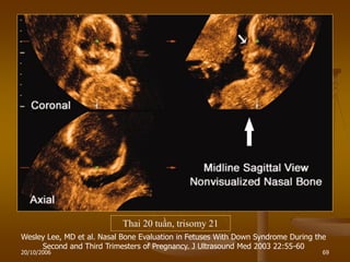 20/10/2006 69
Thai 20 tuần, trisomy 21
Wesley Lee, MD et al. Nasal Bone Evaluation in Fetuses With Down Syndrome During the
Second and Third Trimesters of Pregnancy. J Ultrasound Med 2003 22:55-60
 