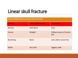 Linear skull fracture
Linear skull fracture vs suture line (on Xray)
Feature Linear skull fracture Suture line
Density Dark black Grey
Course Straight Follows course of suture
line
Branching None Joins other suture line
Width Very thin Jagged, wide
 
