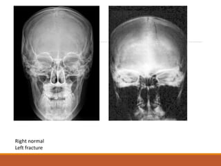 Right normal
Left fracture
 