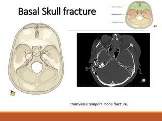 Basal Skull fracture
transverse temporal bone fracture.
 
