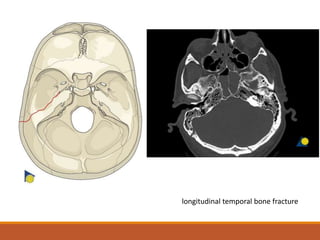 longitudinal temporal bone fracture
 