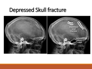 Depressed Skull fracture
 