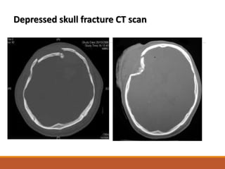 Depressed skull fracture CT scan
 