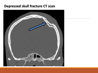 Depressed skull fracture CT scan
 