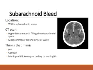 Subarachnoid Bleed
Location:
◦ Within subarachnoid space
CT scan:
◦ Hyperdense material filling the subarachnoid
space
◦ Most commonly around circle of Willlis
Things that mimic
◦ pus
◦ Contrast
◦ Meningeal thickening secondary to meningitis
 