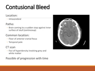 Contusional Bleed
Location:
◦ Intracerebral
Patho:
◦ Brain coming to a sudden stop against inner
surface of skull (contrecoup)
Common location:
◦ Floor of anterior cranial fossa
◦ Temporal pole
CT scan
◦ Foci of hyperdensity involving grey and
white matter
Possible of progression with time
 