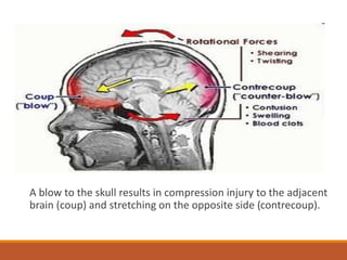 A blow to the skull results in compression injury to the adjacent
brain (coup) and stretching on the opposite side (contrecoup).
 
