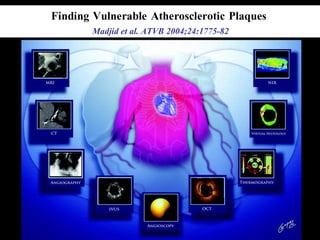 Madjid et al. ATVB 2004;24:1775-82
 
