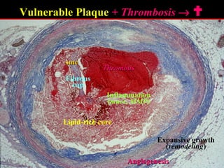 ThrombusThrombus
Lipid-rich core
Vulnerable Plaque + Thrombosis+ Thrombosis →→ 
Fibrous
cap
Inflammation
(macr, MMP)
smcsmc
Expansive growth
(remodeling)
AngiogenesisAngiogenesis
 