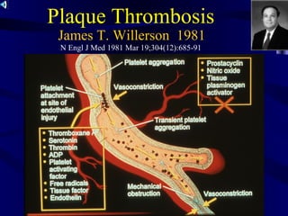 James T. Willerson 1981
N Engl J Med 1981 Mar 19;304(12):685-91
Plaque Thrombosis
 