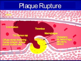 PlaqueRupture
 