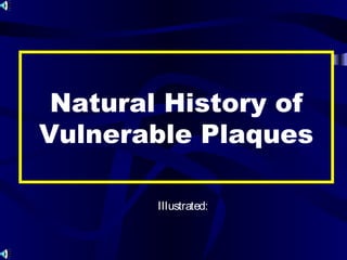 Natural History of
Vulnerable Plaques
Illustrated:
 
