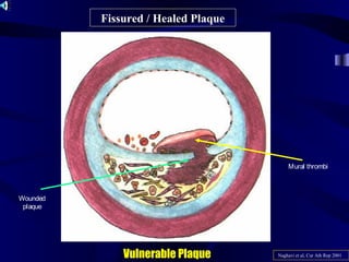 Fissured / Healed Plaque
Vulnerable Plaque Naghavi et al, Cur Ath Rep 2001
Mural thrombi
Wounded
plaque
 