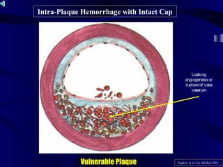 Intra-Plaque Hemorrhage with Intact Cap
Vulnerable Plaque Naghavi et al, Cur Ath Rep 2001
Leaking
angiogenesisor
ruptureof vasa
vaserum
 