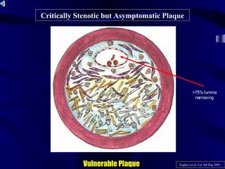 Critically Stenotic but Asymptomatic Plaque
Naghavi et al, Cur Ath Rep 2001Vulnerable Plaque
>75% lumina
narrowing
 