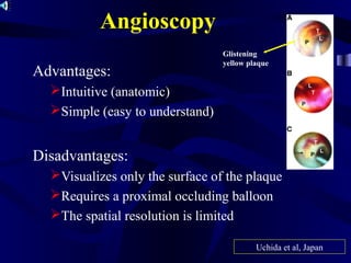 Angioscopy
Advantages:
Intuitive (anatomic)
Simple (easy to understand)
Disadvantages:
Visualizes only the surface of the plaque
Requires a proximal occluding balloon
The spatial resolution is limited
Glistening
yellow plaque
Uchida et al, Japan
 
