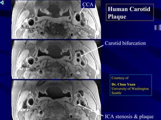 Human Carotid
Plaque
CCA
Carotid bifurcation
ICA stenosis & plaque
Courtesy of
Dr. Chun Yuan
University of Washington
Seattle
 