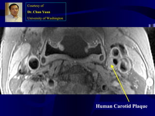 Human Carotid Plaque
Courtesy of
Dr. Chun Yuan
University of Washington
 