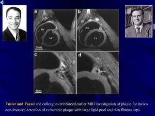 Fuster and Fayad and colleagues reinforced earlier MRI investigation of plaque for invivo
non-invasive detection of vulnerable plaque with large lipid pool and thin fibrous caps.
 
