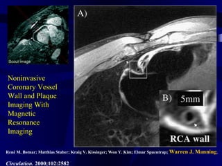 Noninvasive
Coronary Vessel
Wall and Plaque
Imaging With
Magnetic
Resonance
Imaging
René M. Botnar; Matthias Stuber; Kraig V. Kissinger; Won Y. Kim; Elmar Spuentrup; Warren J. Manning.
Circulation. 2000;102:2582
 