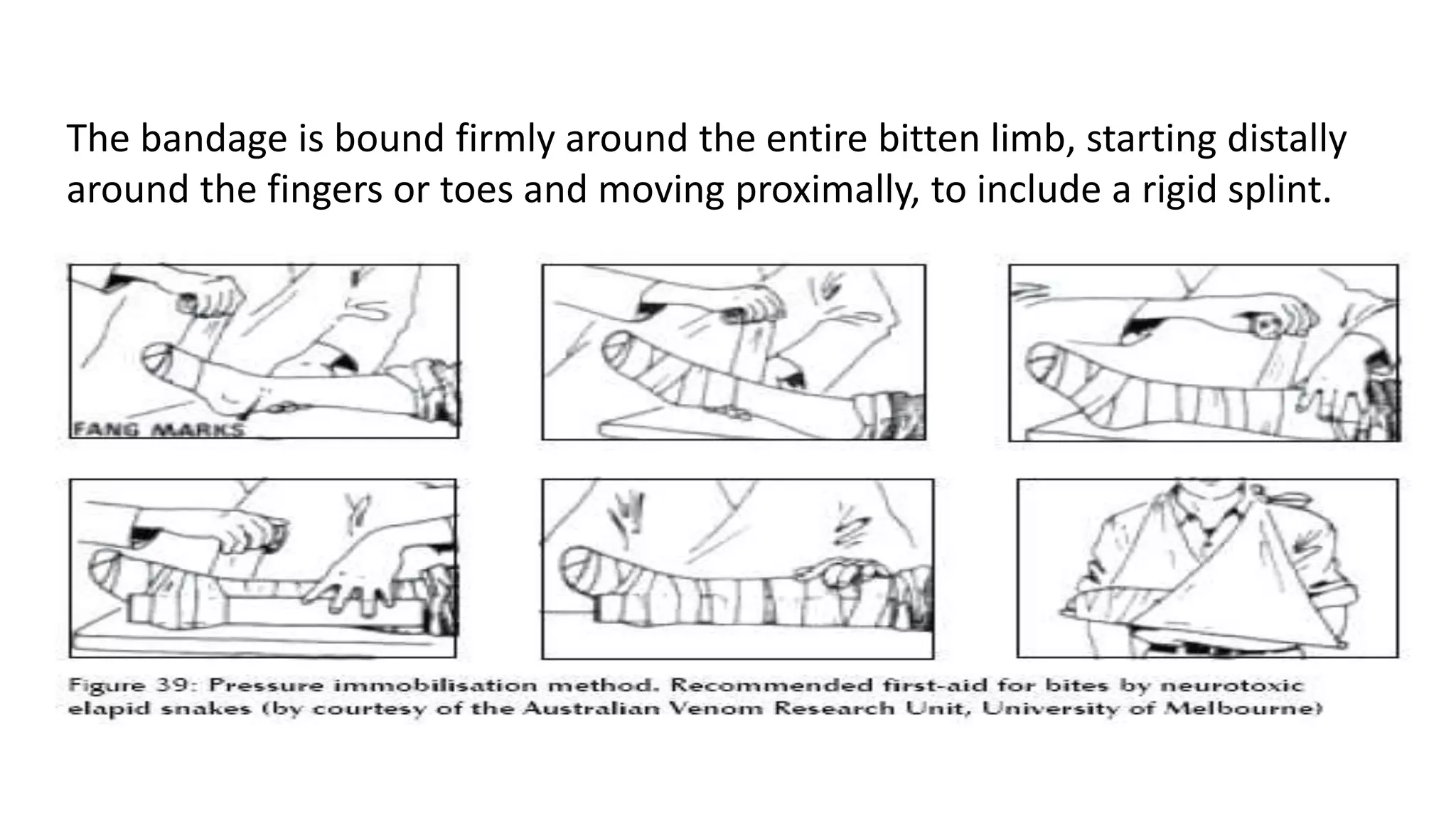 The bandage is bound firmly around the entire bitten limb, starting distally
around the fingers or toes and moving proximally, to include a rigid splint.
 