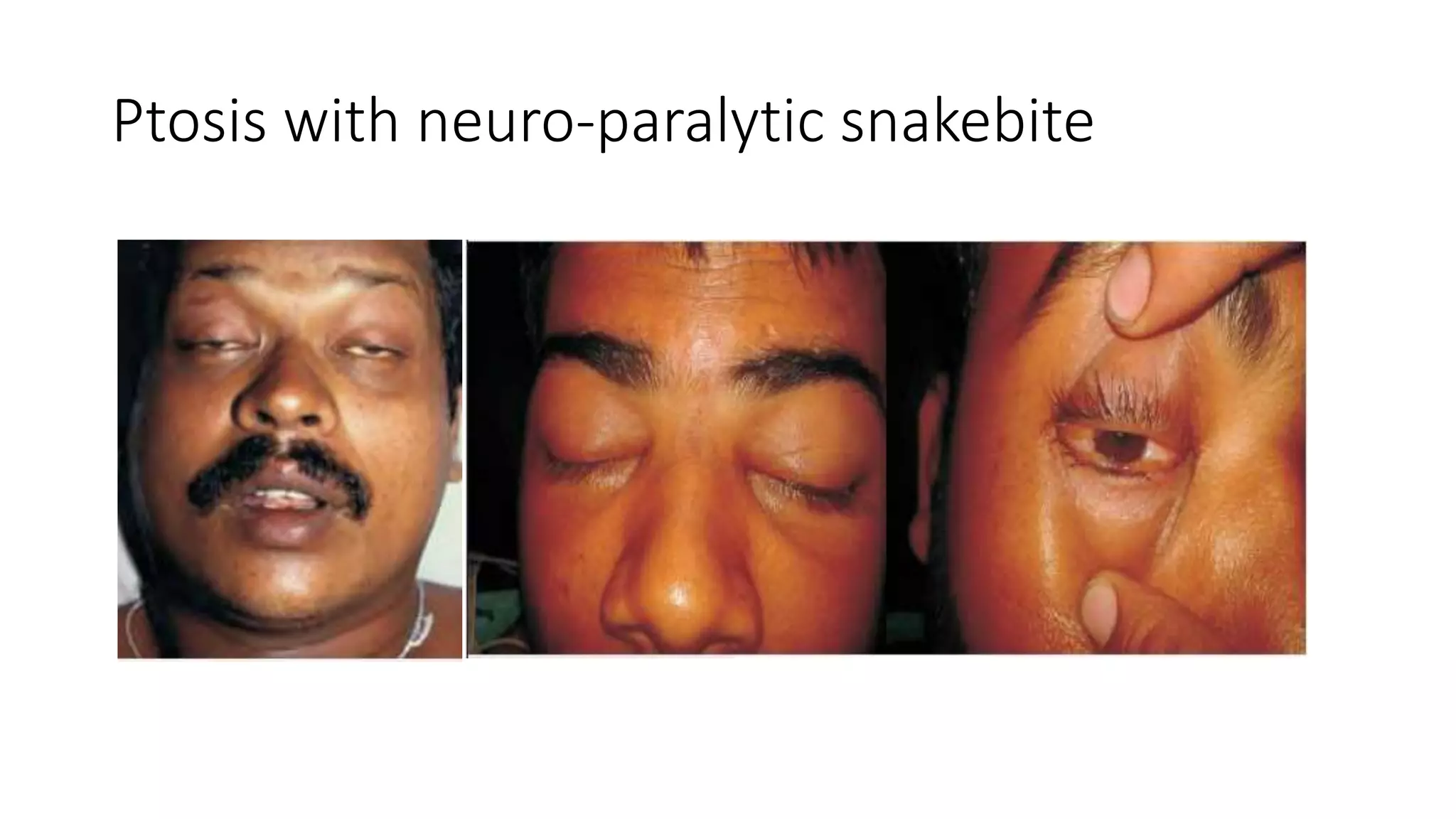 Ptosis with neuro-paralytic snakebite
 