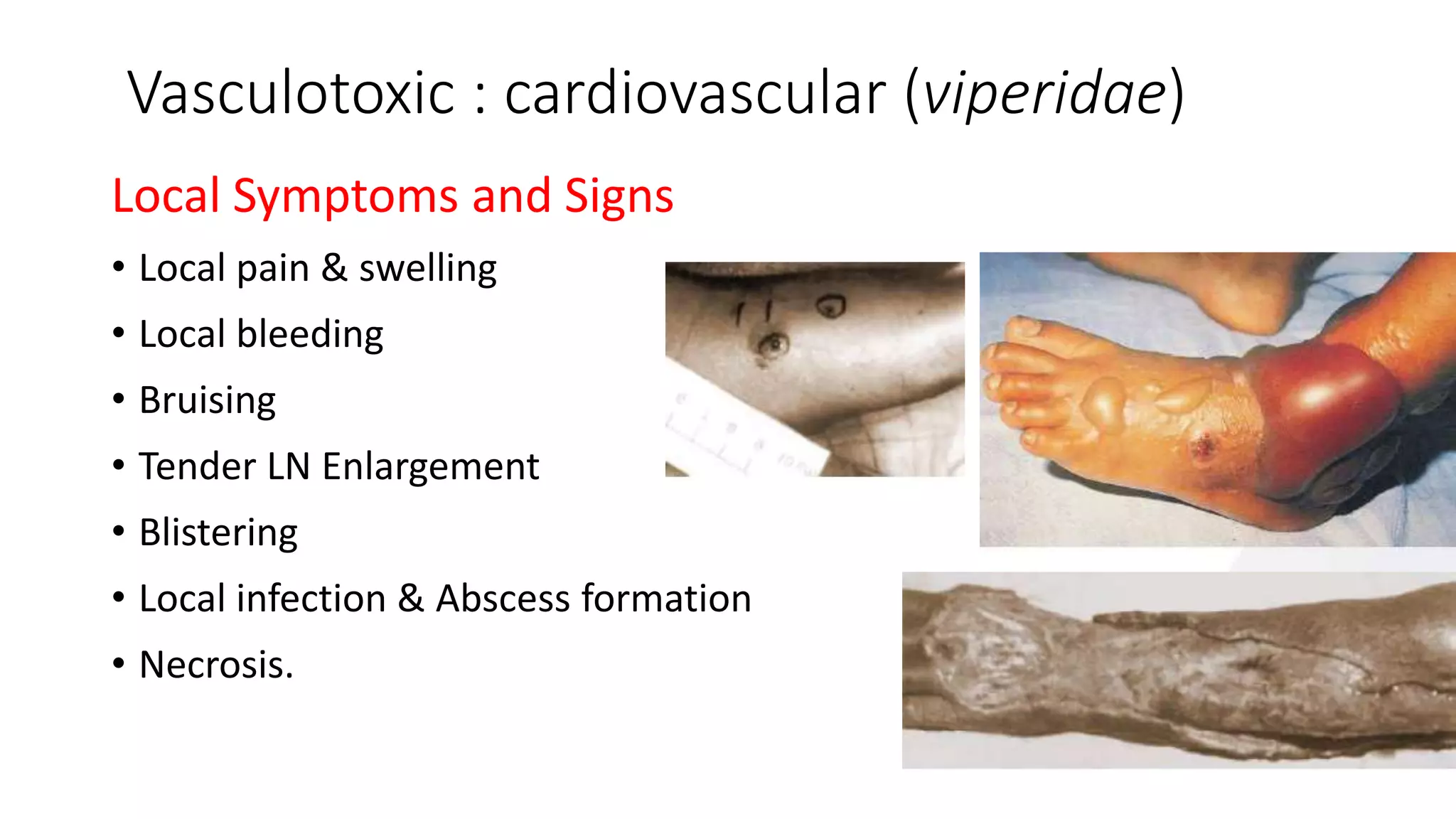 Vasculotoxic : cardiovascular (viperidae)
Local Symptoms and Signs
• Local pain & swelling
• Local bleeding
• Bruising
• Tender LN Enlargement
• Blistering
• Local infection & Abscess formation
• Necrosis.
 