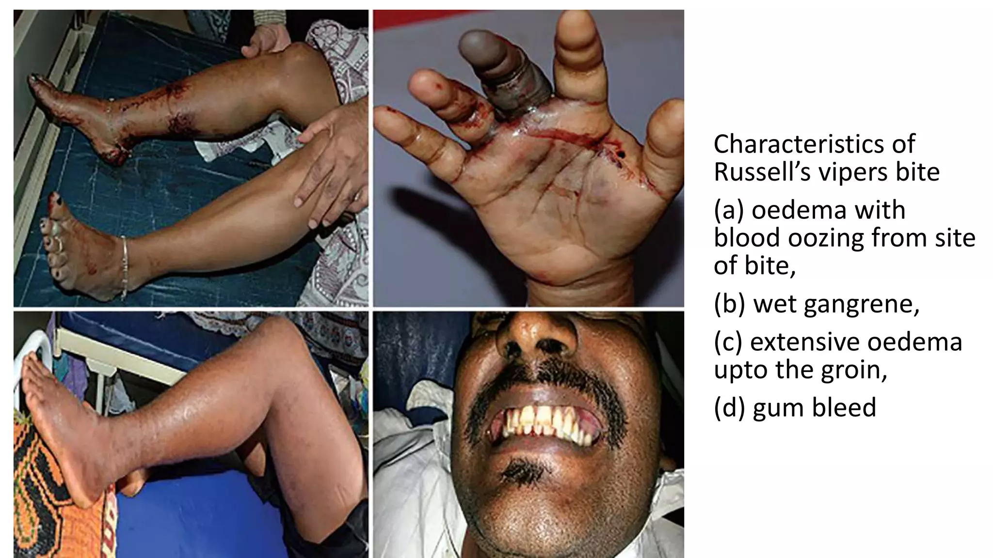 Characteristics of
Russell’s vipers bite
(a) oedema with
blood oozing from site
of bite,
(b) wet gangrene,
(c) extensive oedema
upto the groin,
(d) gum bleed
 