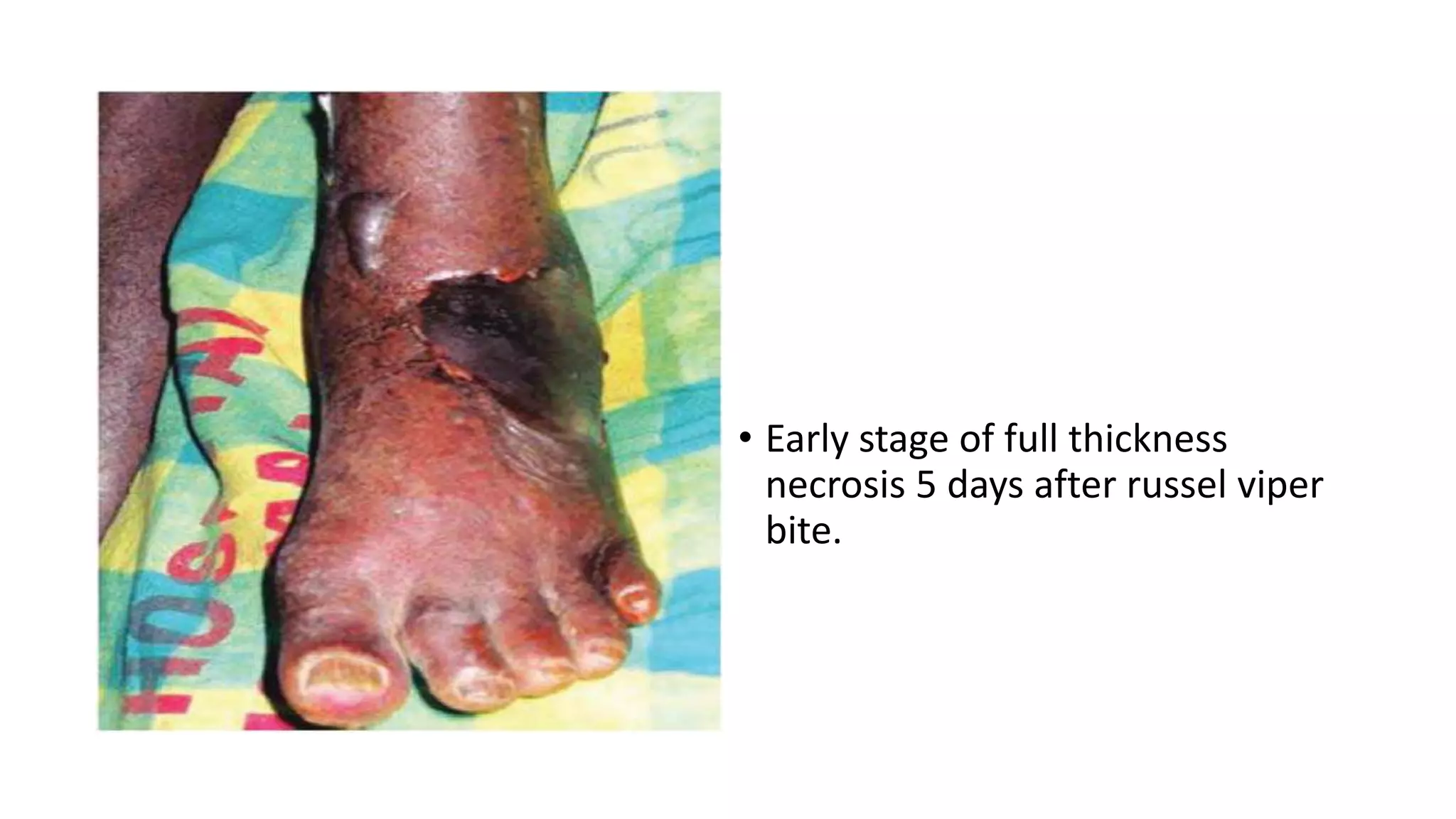 • Early stage of full thickness
necrosis 5 days after russel viper
bite.
 