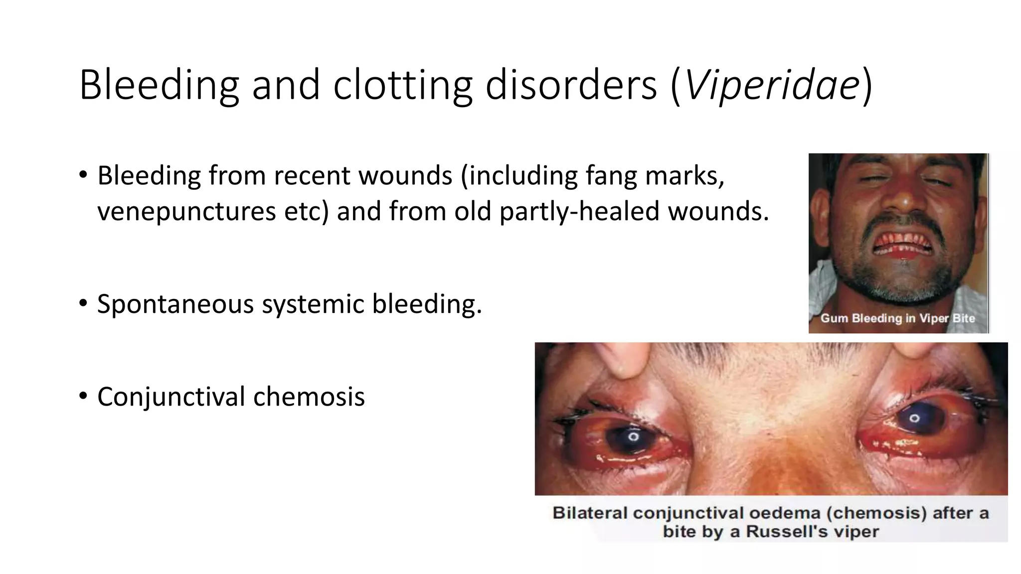 Bleeding and clotting disorders (Viperidae)
• Bleeding from recent wounds (including fang marks,
venepunctures etc) and from old partly-healed wounds.
• Spontaneous systemic bleeding.
• Conjunctival chemosis
 