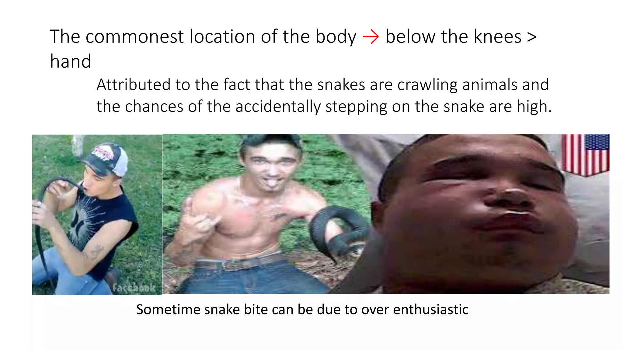 The commonest location of the body → below the knees >
hand
Attributed to the fact that the snakes are crawling animals and
the chances of the accidentally stepping on the snake are high.
Sometime snake bite can be due to over enthusiastic
 