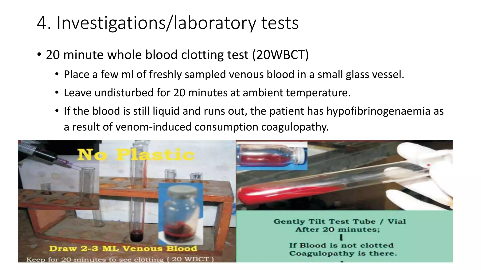 4. Investigations/laboratory tests
• 20 minute whole blood clotting test (20WBCT)
• Place a few ml of freshly sampled venous blood in a small glass vessel.
• Leave undisturbed for 20 minutes at ambient temperature.
• If the blood is still liquid and runs out, the patient has hypofibrinogenaemia as
a result of venom-induced consumption coagulopathy.
 