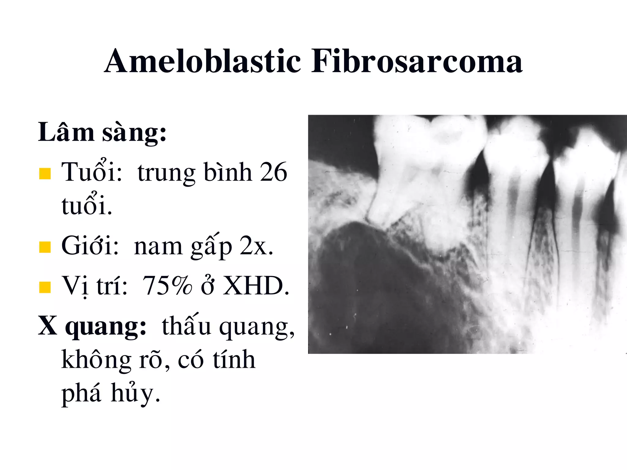 Ameloblastic Fibrosarcoma
Laâm saøng:
 Tuoåi: trung bình 26
tuoåi.
 Giôùi: nam gaáp 2x.
 Vò trí: 75% ôû XHD.
X quang: thaáu quang,
khoâng roõ, coù tính
phaù huûy.
 