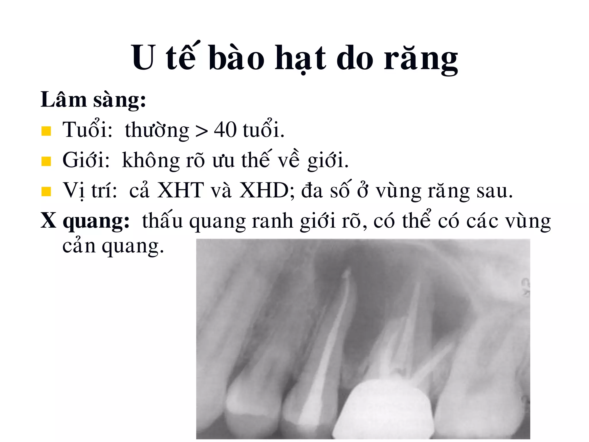 U teá baøo haït do raêng
Laâm saøng:
 Tuoåi: thöôøng > 40 tuoåi.
 Giôùi: khoâng roõ öu theá veà giôùi.
 Vò trí: caû XHT vaø XHD; ña soá ôû vuøng raêng sau.
X quang: thaáu quang ranh giôùi roõ, coù theå coù caùc vuøng
caûn quang.
 