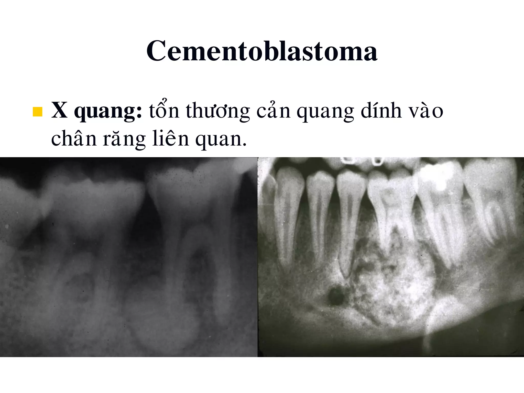 Cementoblastoma
 X quang: toån thöông caûn quang dính vaøo
chaân raêng lieân quan.
 