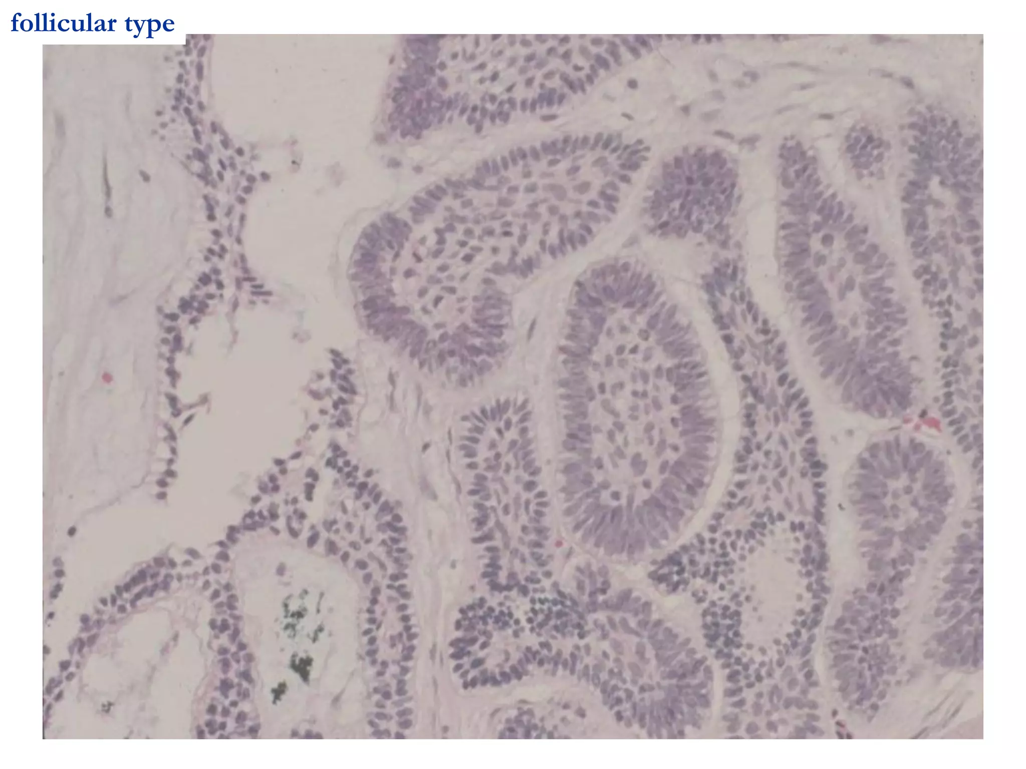 follicular type
 