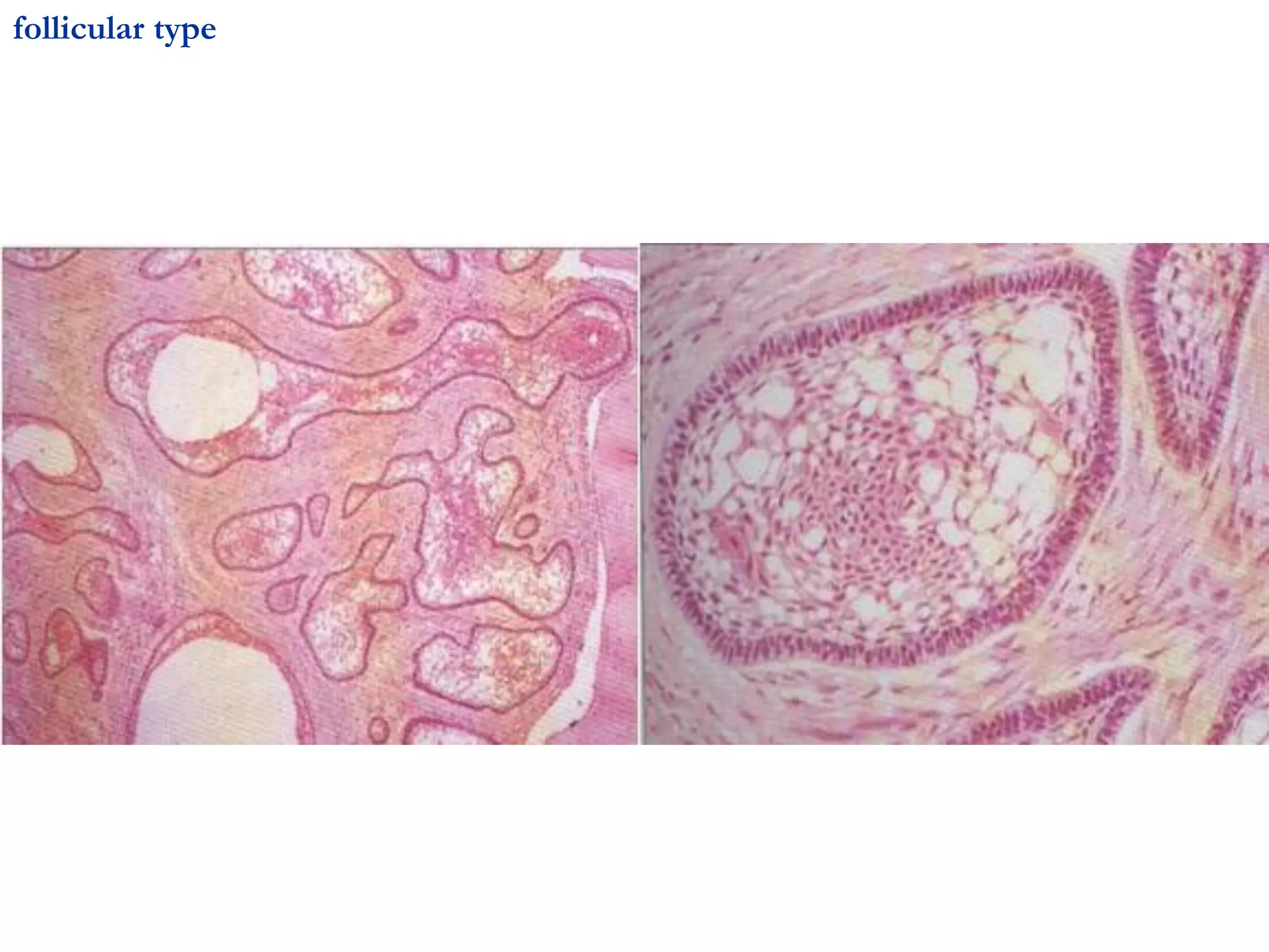 follicular type
 