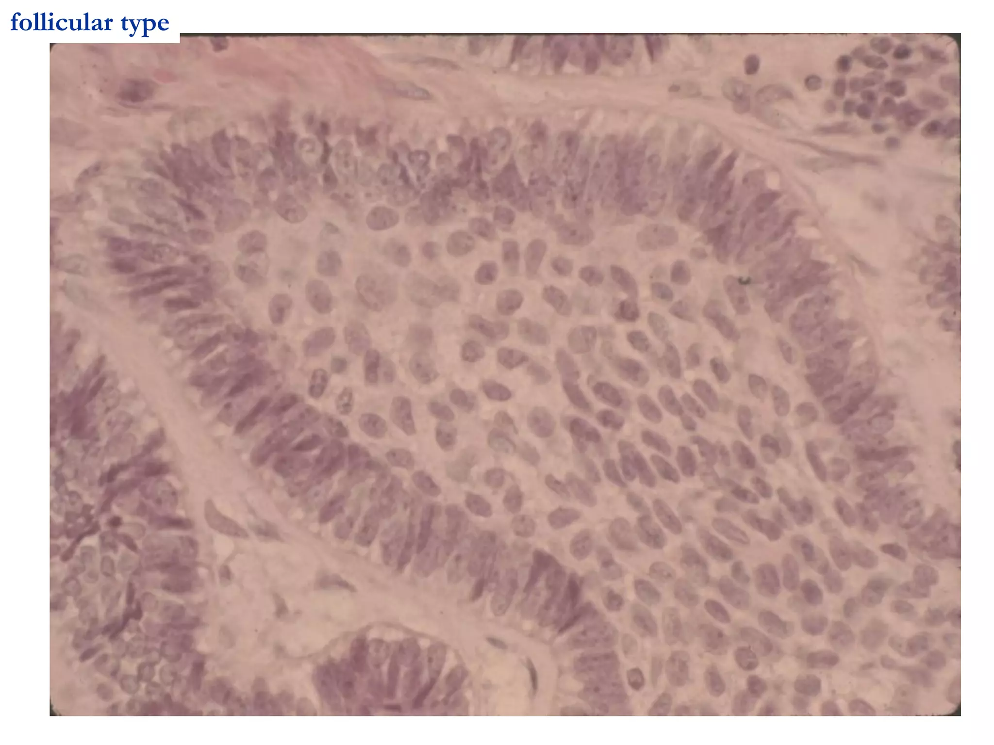 follicular type
 