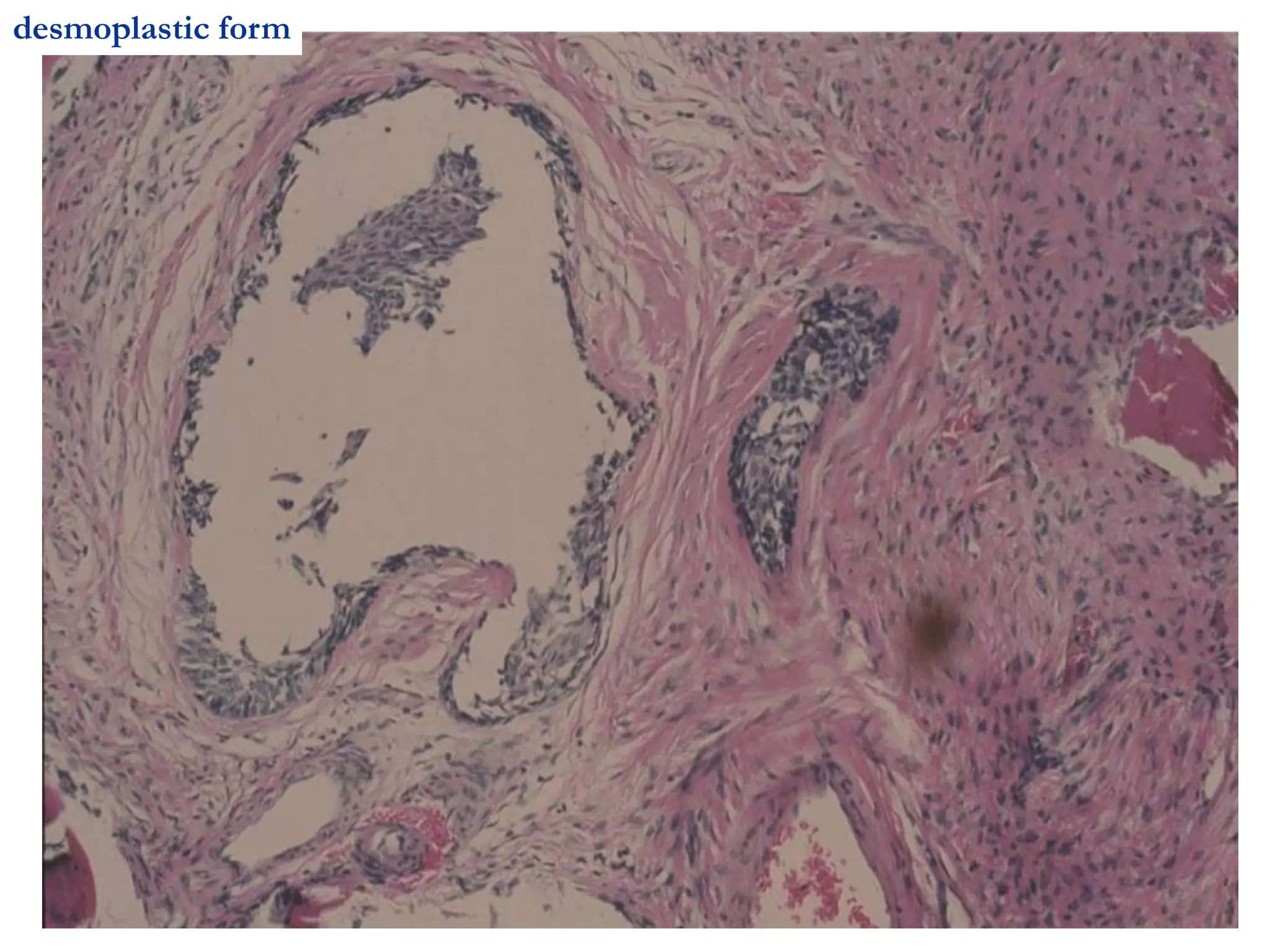 desmoplastic form
 
