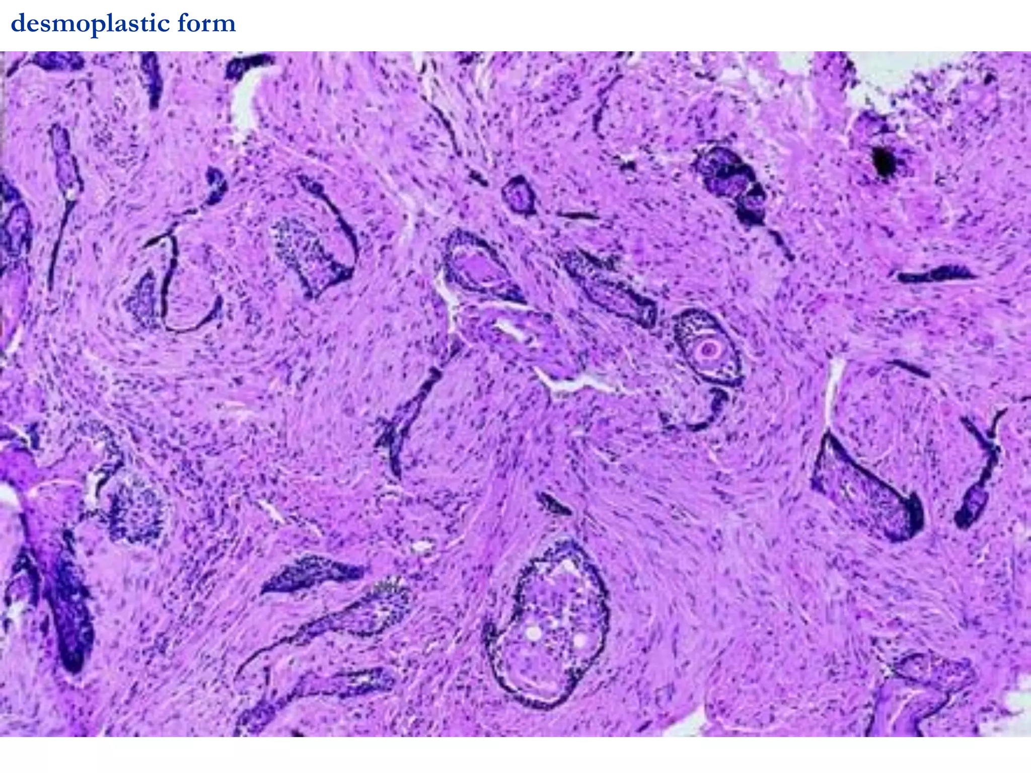 desmoplastic form
 