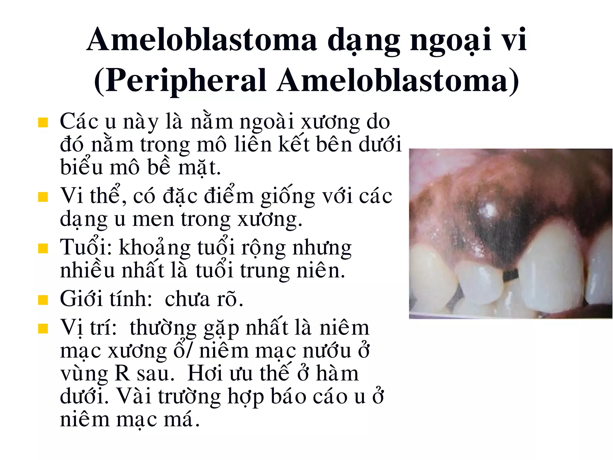 Ameloblastoma daïng ngoaïi vi
(Peripheral Ameloblastoma)
 Caùc u naøy laø naèm ngoaøi xöông do
ñoù naèm trong moâ lieân keát beân döôùi
bieåu moâ beà maët.
 Vi theå, coù ñaëc ñieåm gioáng vôùi caùc
daïng u men trong xöông.
 Tuoåi: khoaûng tuoåi roäng nhöng
nhieàu nhaát laø tuoåi trung nieân.
 Giôùi tính: chöa roõ.
 Vò trí: thöôøng gaëp nhaát laø nieâm
maïc xöông oå/ nieâm maïc nöôùu ôû
vuøng R sau. Hôi öu theá ôû haøm
döôùi. Vaøi tröôøng hôïp baùo caùo u ôû
nieâm maïc maù.
 