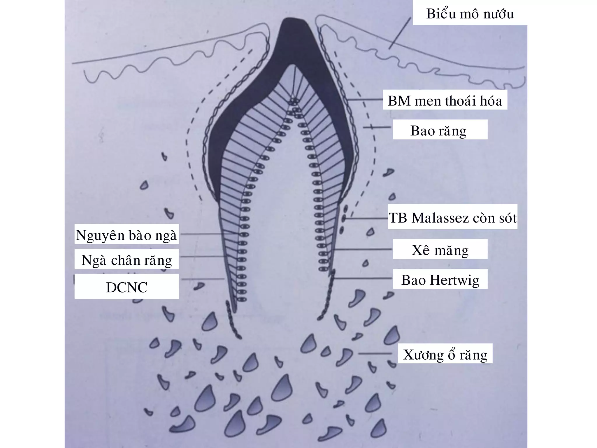 Bao raêng
TB Malassez coøn soùt
Bao Hertwig
Nguyeân baøo ngaø
Xeâ maêng
Ngaø chaân raêng
DCNC
Bieåu moâ nöôùu
Xöông oå raêng
BM men thoaùi hoùa
 