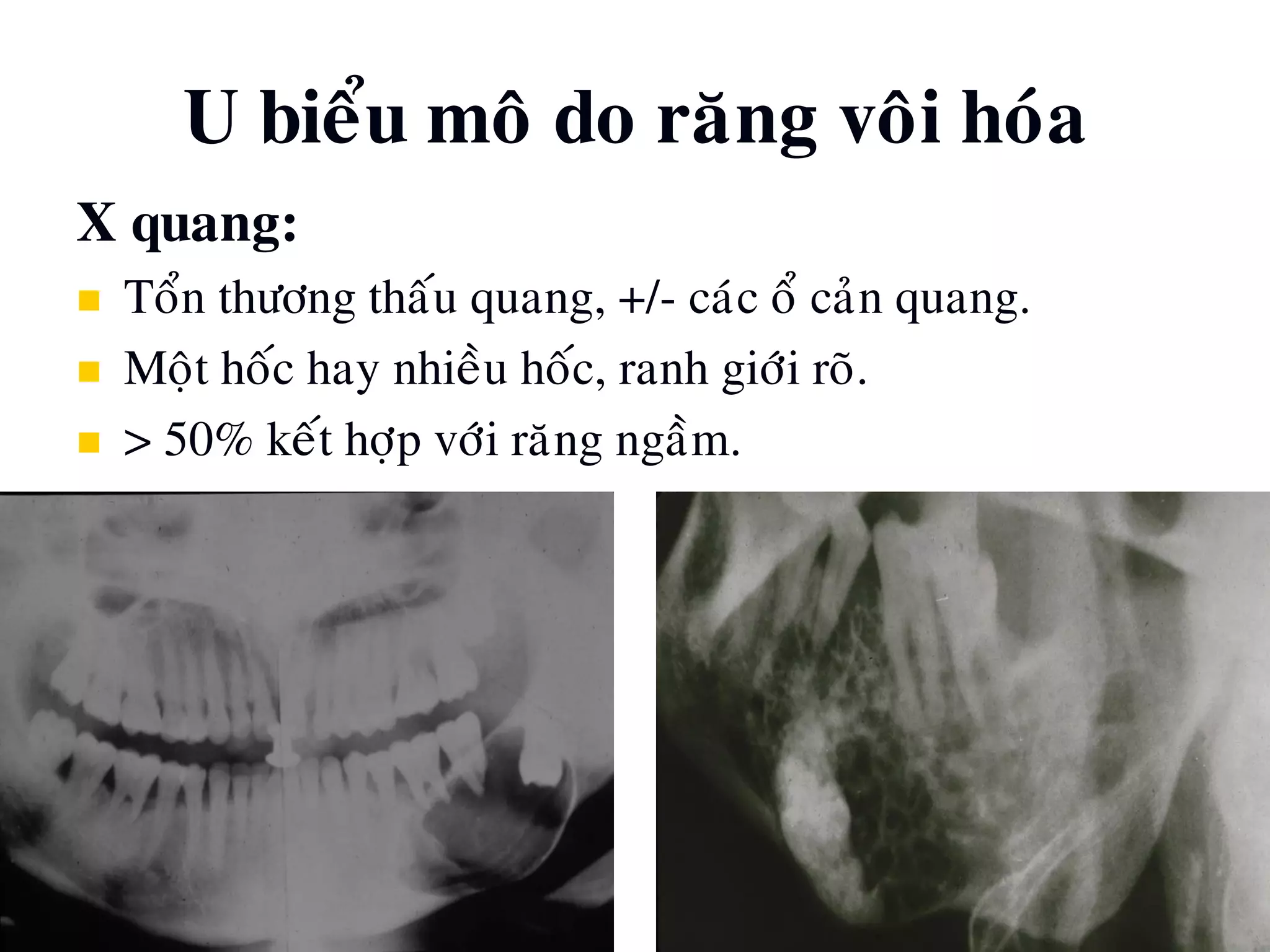 U bieåu moâ do raêng voâi hoùa
X quang:
 Toån thöông thaáu quang, +/- caùc oå caûn quang.
 Moät hoác hay nhieàu hoác, ranh giôùi roõ.
 > 50% keát hôïp vôùi raêng ngaàm.
 