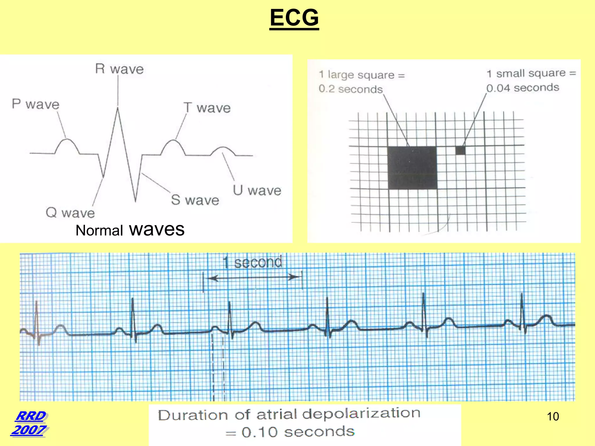 ECG

Normal

waves

10

 