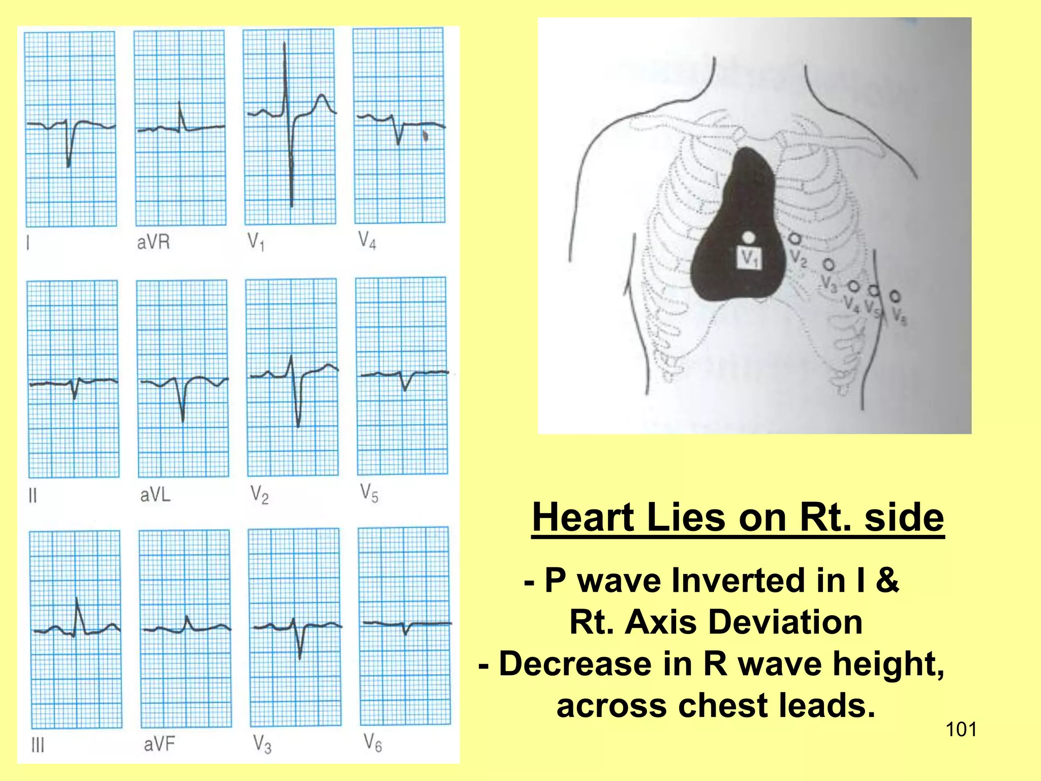Heart Lies on Rt. side
- P wave Inverted in I &
Rt. Axis Deviation
- Decrease in R wave height,
across chest leads.

101

 