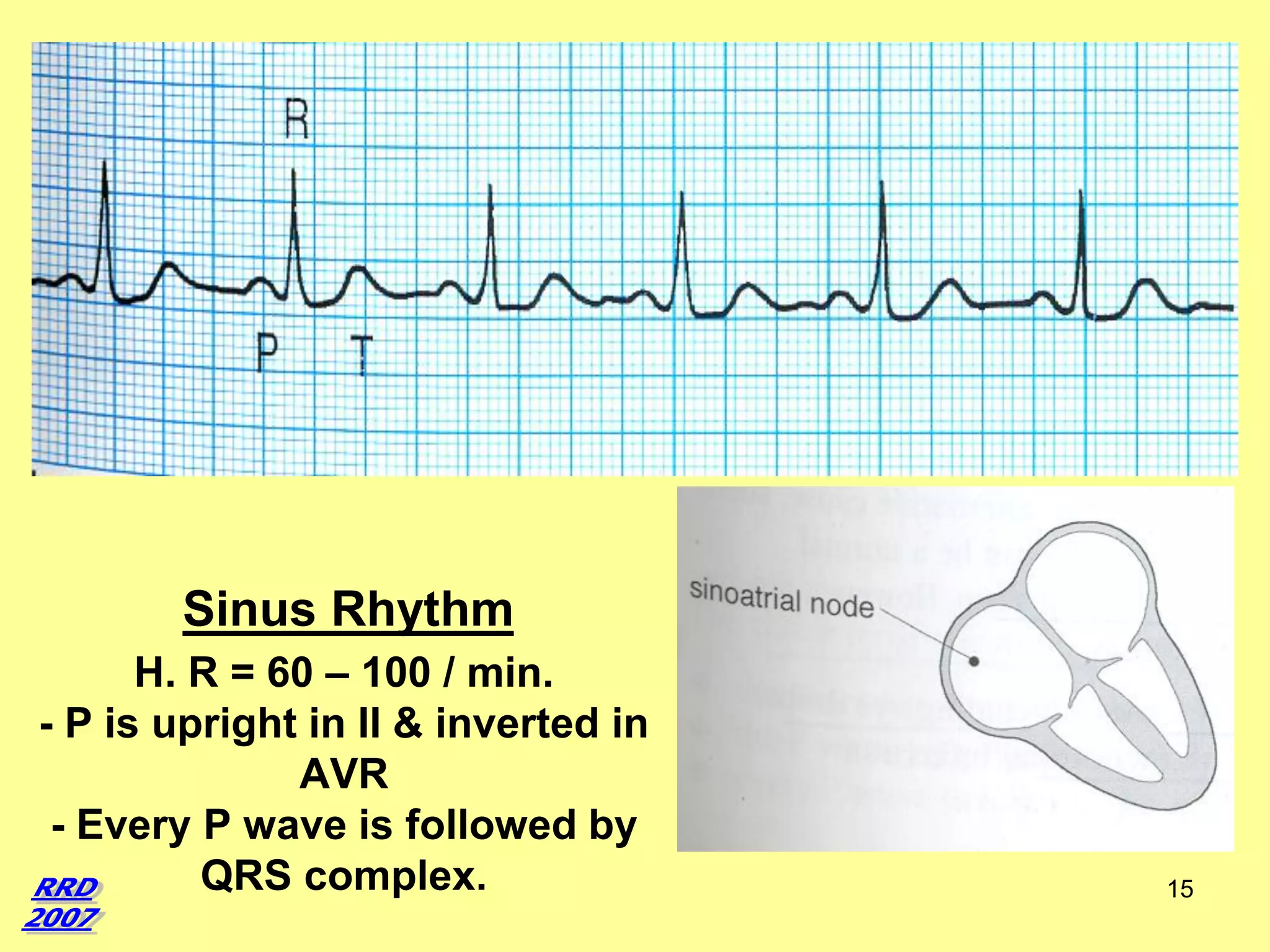 Sinus Rhythm
H. R = 60 – 100 / min.
- P is upright in II & inverted in
AVR
- Every P wave is followed by
QRS complex.

15

 