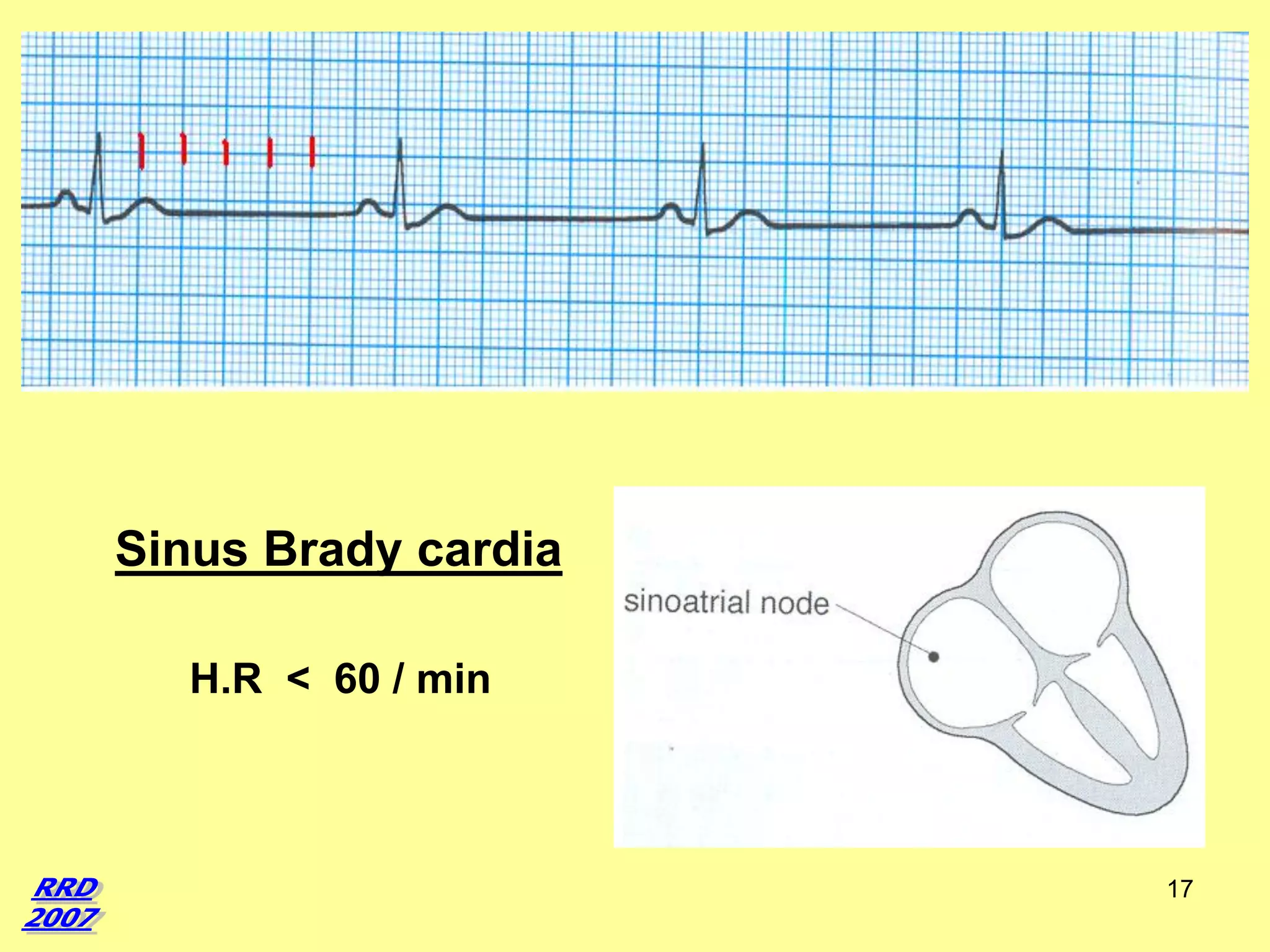 Sinus Brady cardia
H.R < 60 / min

17

 