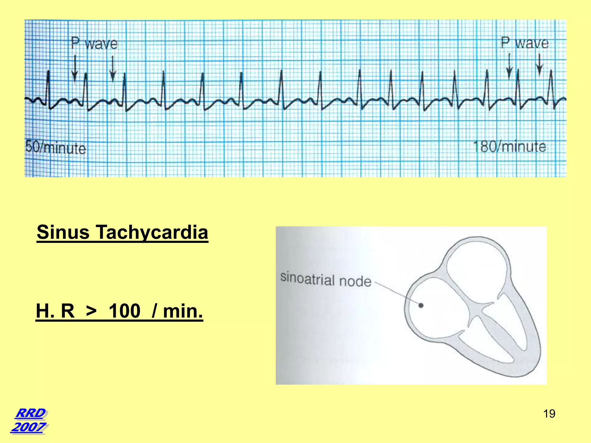 Sinus Tachycardia

H. R > 100 / min.

19

 